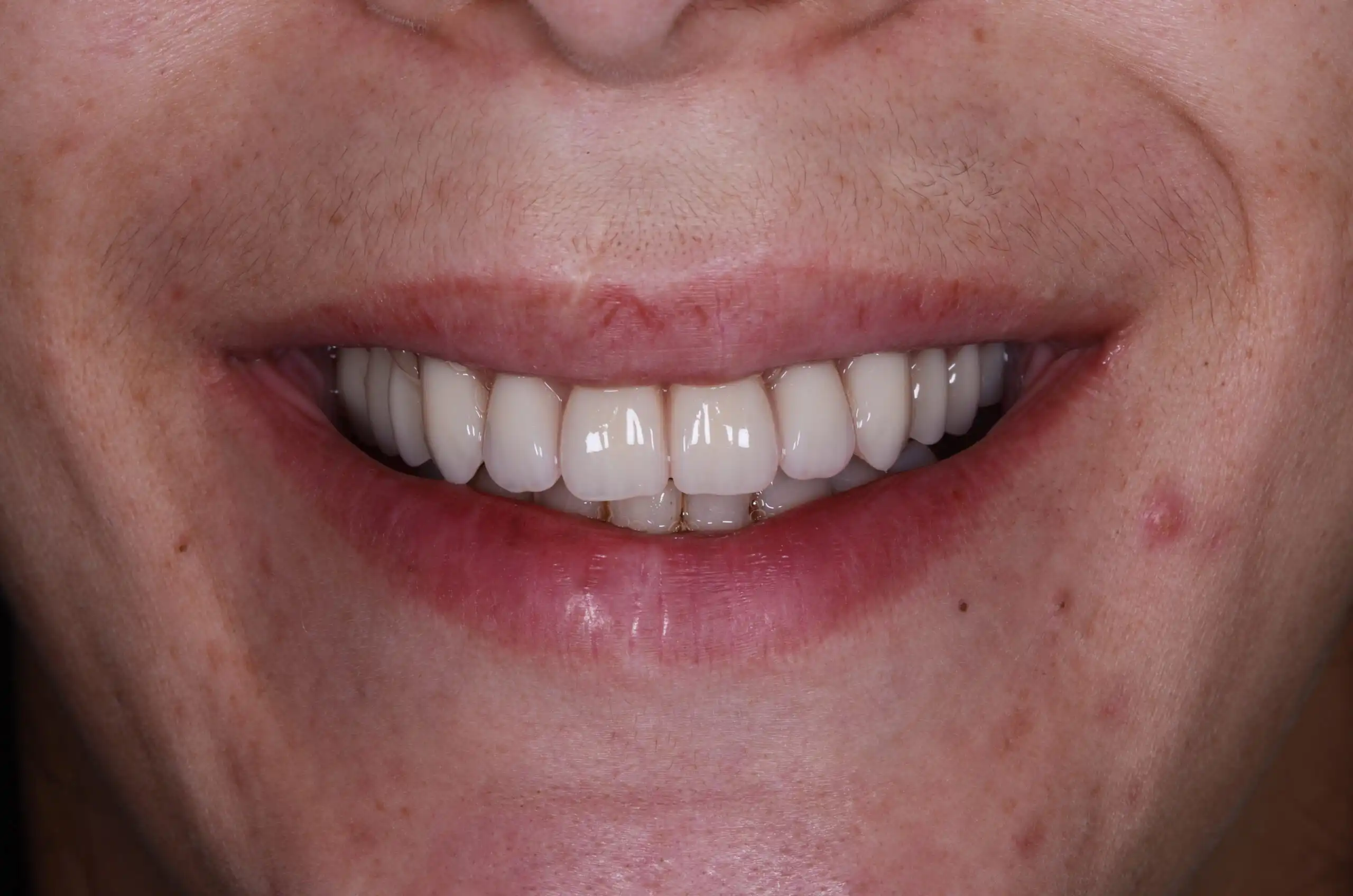 Sorriso com dentes alinhados, destacando uma estética dentária de alta qualidade.