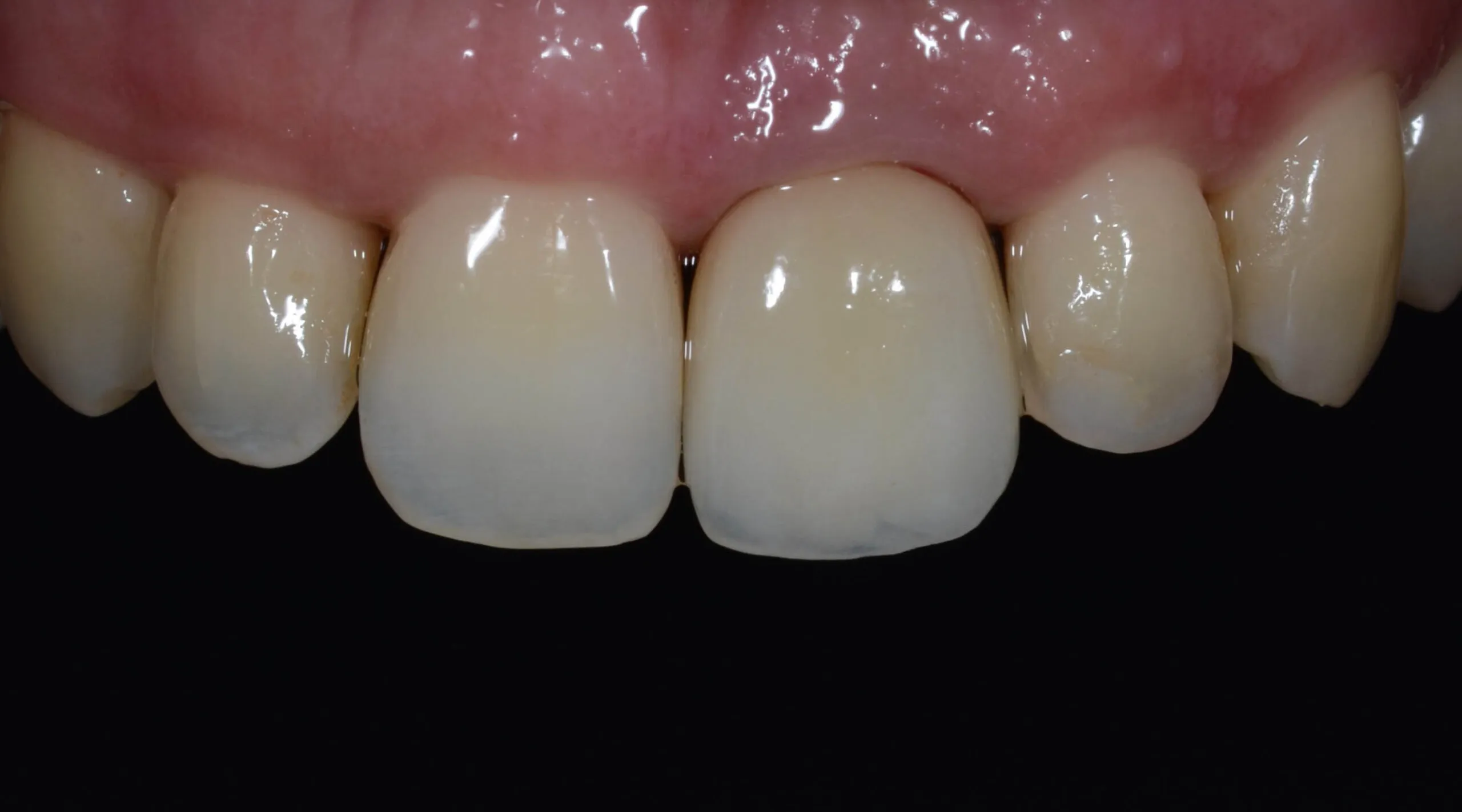 Arcada dentária superior com todos os dentes.