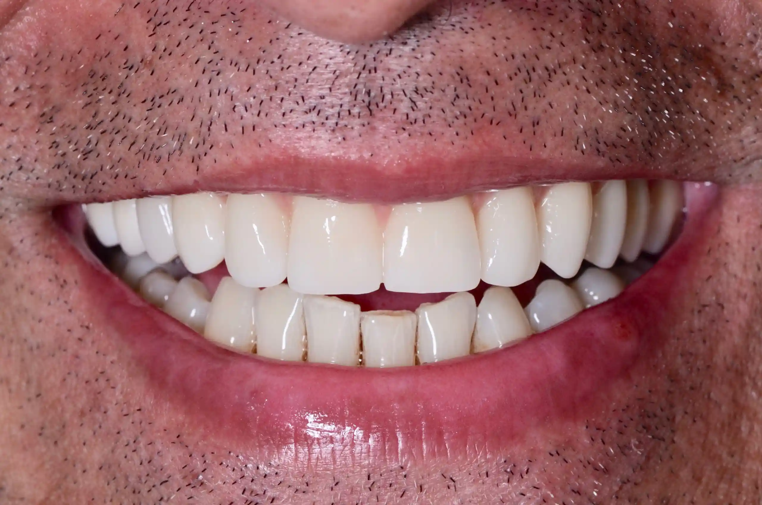 Sorriso após o implante e tratamento.