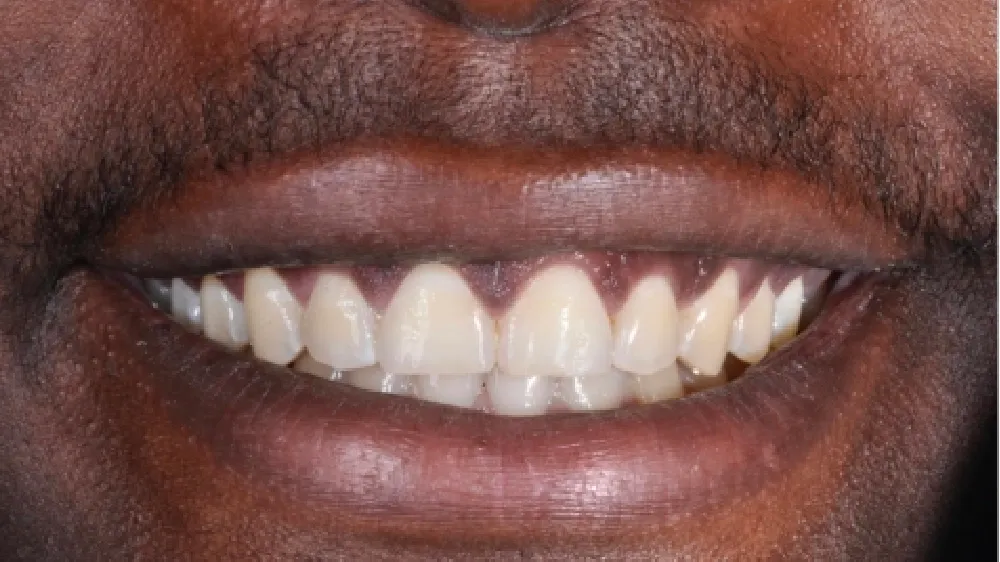 Dentes saudáveis após o tratamento