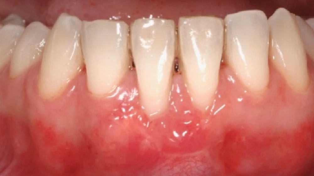 Dentes após tratamento com melhora nas gengivas.