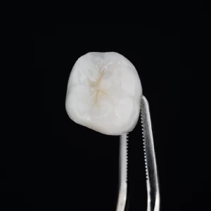 Foco num dente moldado e finalizado.