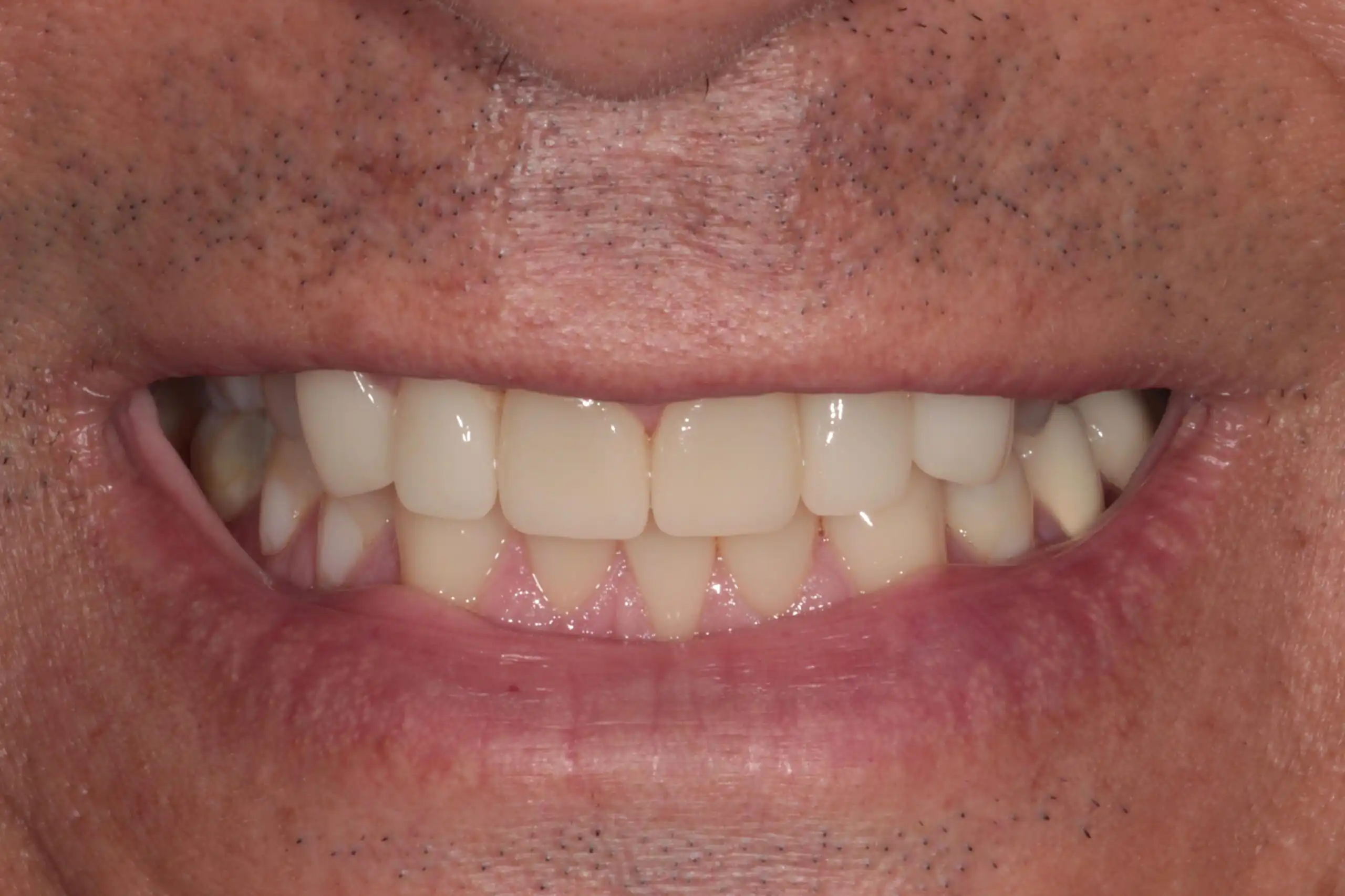 Sorriso a mostrar dentes brancos e alinhados, destacando a reabilitação oral.